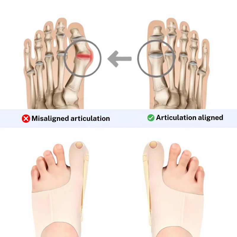 ORTHOSOFT | Discreet orthosis for hallux valgus