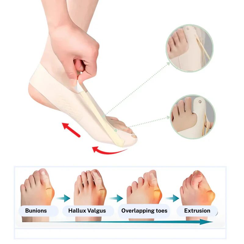 ORTHOSOFT | Discreet orthosis for hallux valgus